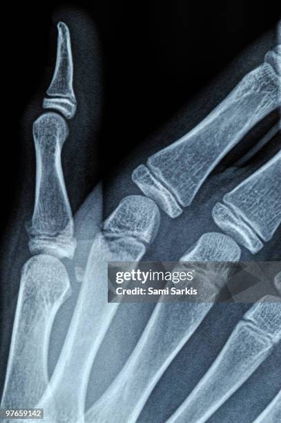 x-ray image of boy's (13) right hand - phalanx stock pictures, royalty-free photos & images