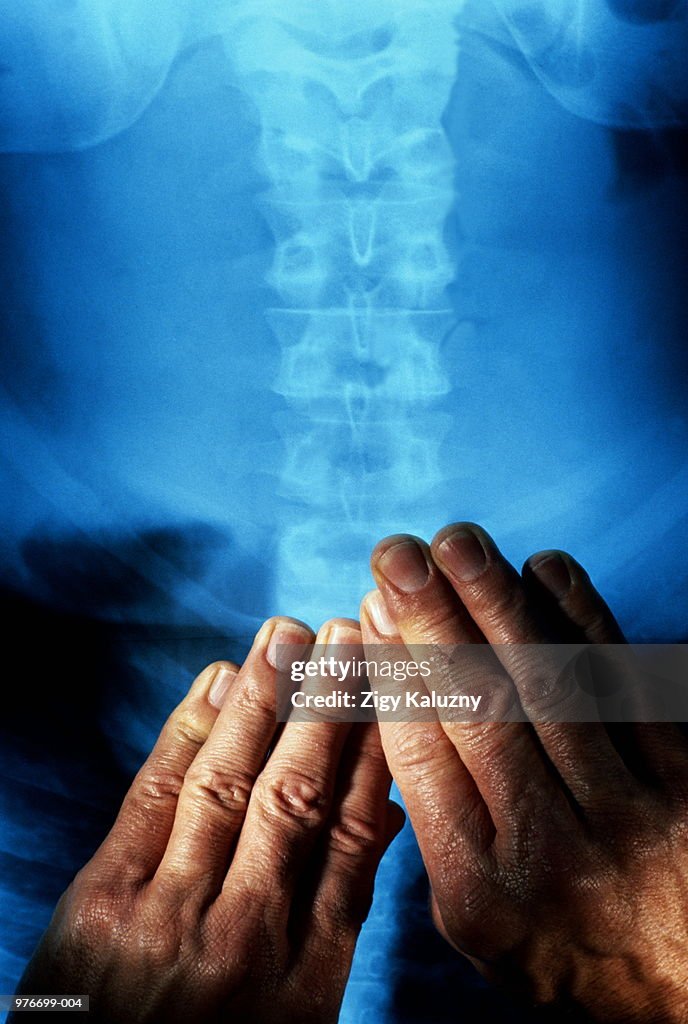 Hands resting on X-ray, as if massaging spine, close-up