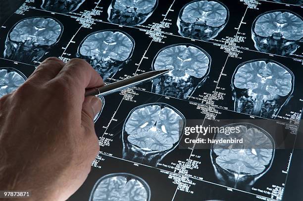 mri brain scan of head and skull with hand pointing - mri scan medische scan stockfoto's en -beelden