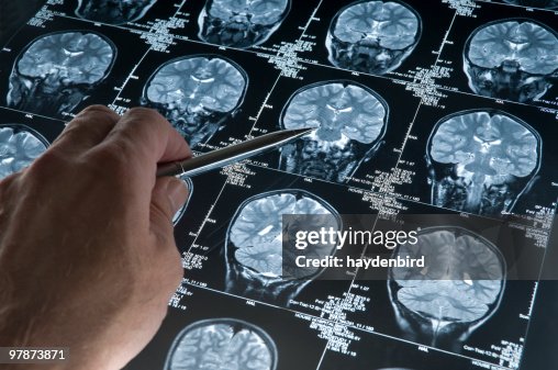 MRI Brain Scan of head and skull with hand pointing MRI Brain Scan of head and skull with hand pointing
