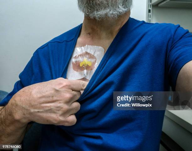 cancer chemotherapy drug patient waiting for intravenous infusion - chemotherapy man stock pictures, royalty-free photos & images
