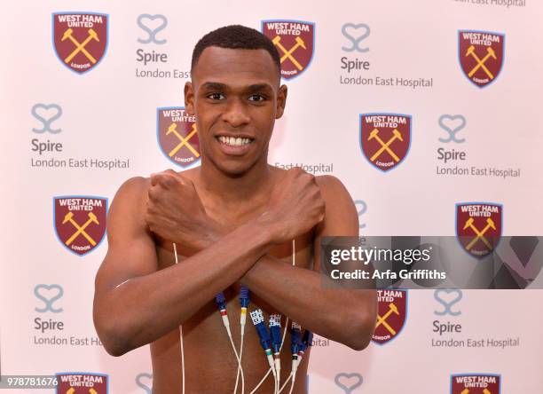 New signing Issa Diop of West Ham United undergoes his medical at Spire London East Hospital on June 19, 2018 in London, England.