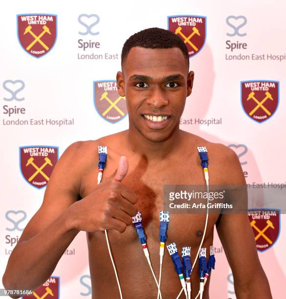 New signing Issa Diop of West Ham United undergoes his medical at Spire London East Hospital on June 19, 2018 in London, England.