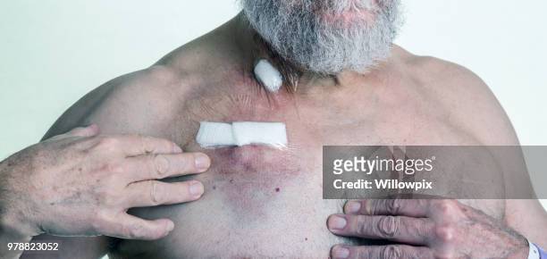 ältere erwachsene mann krebs patienten subkutane chemotherapie iv brust port katheter - bruised finger stock-fotos und bilder