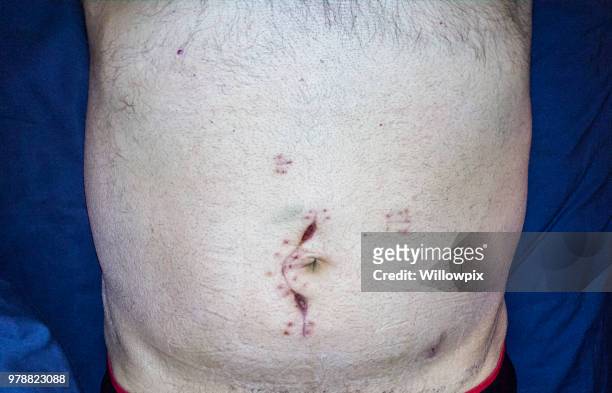 abdominal emergency cancer surgery incision scar close-up selfie - human small intestine stock pictures, royalty-free photos & images