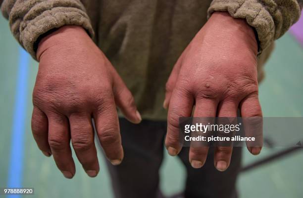 Homeless man showing his frozen hands in a gym in Hamburg, Germany, 27 February 2018. The professional first-league boxing gym Hamburg Giants has put...