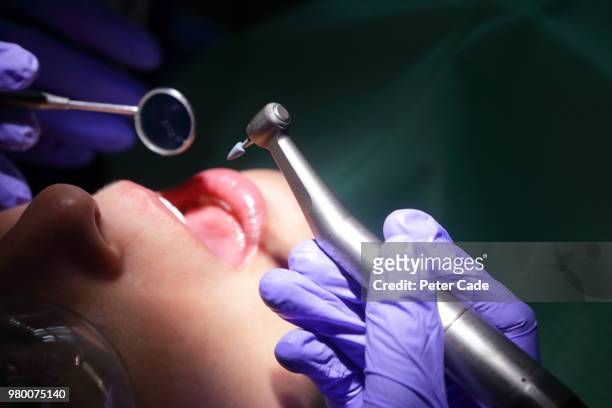 close up of dentistry procedure - wortelkanaal stockfoto's en -beelden
