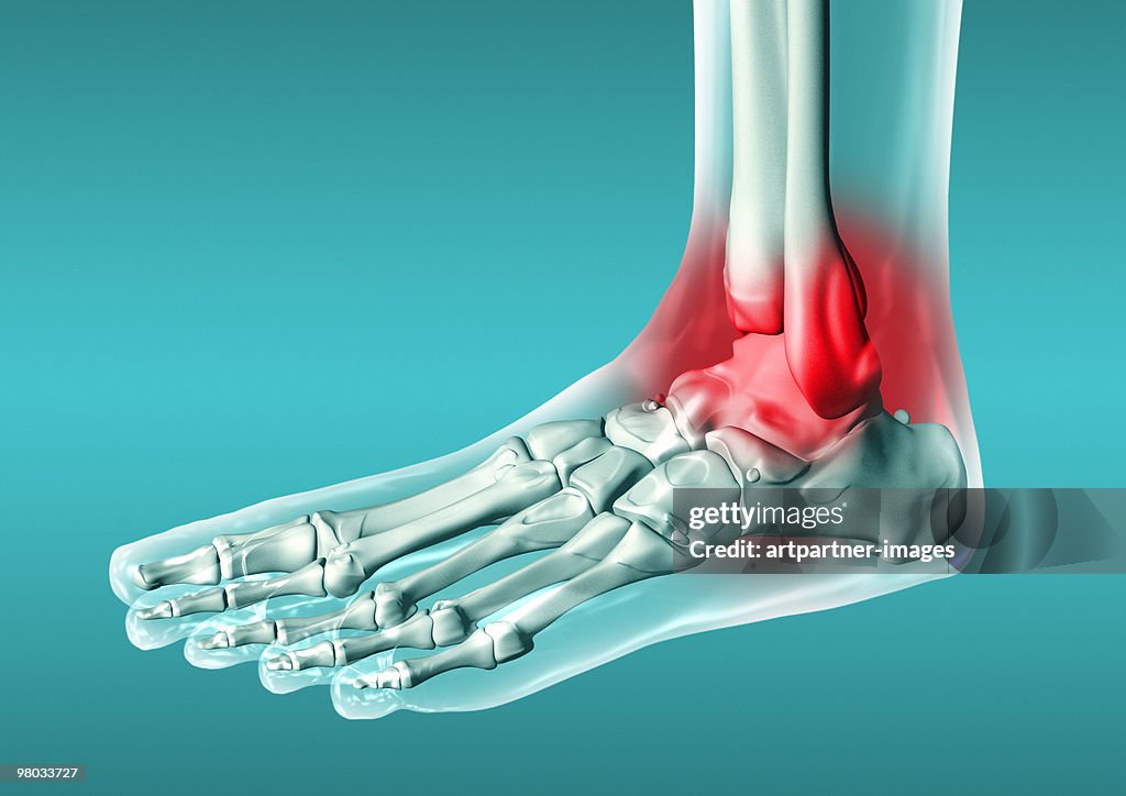 Foot Joint, Inflamation, Osteoarthritis