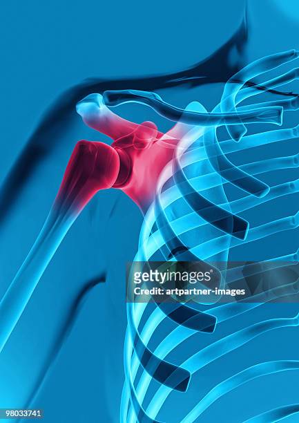 shoulder with joint inflamation - shoulder bone stock pictures, royalty-free photos & images