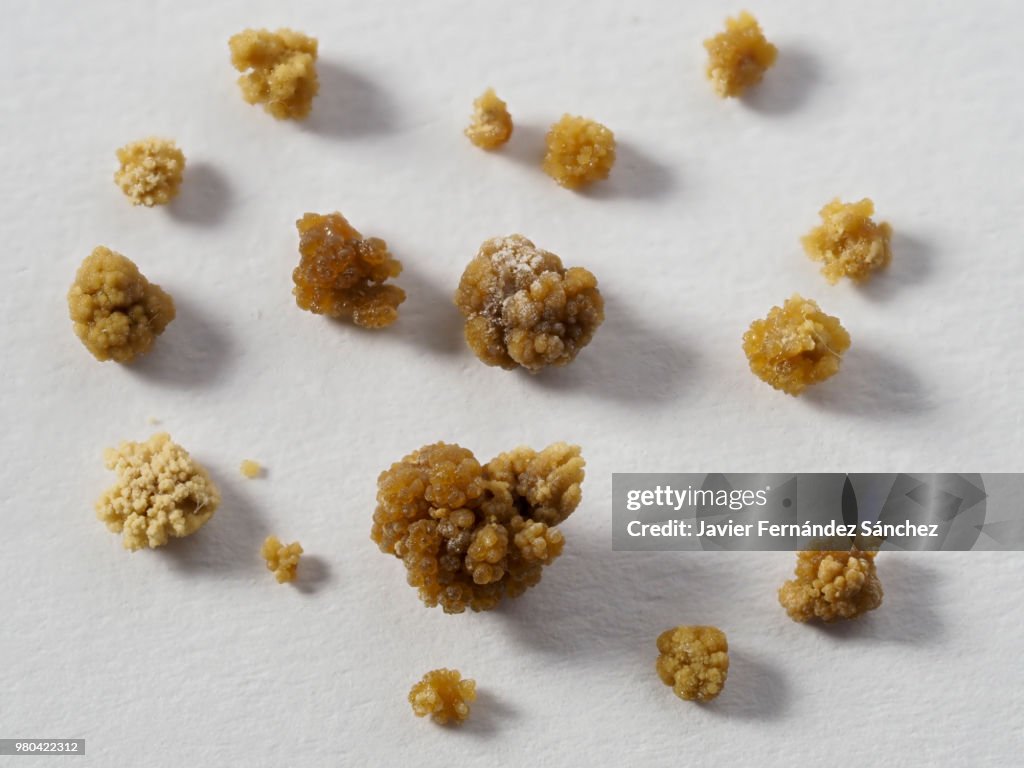 A set of kidney stones of different sizes.