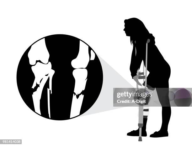 stockillustraties, clipart, cartoons en iconen met brokenkneeboneinjury - inzoomen