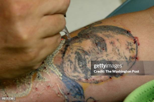 Dr. Colin Berry using a cosmetic laser to remove gang tattoos from the arms and hands of former gang members. Here, Berry works on a large tattoo on...