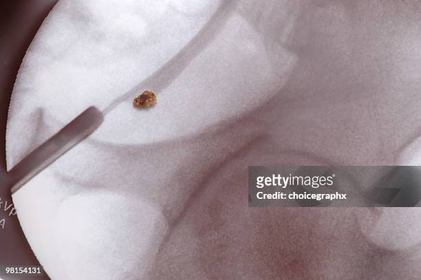 calcolo renale posizionato ai raggi x - kidney stone foto e immagini stock