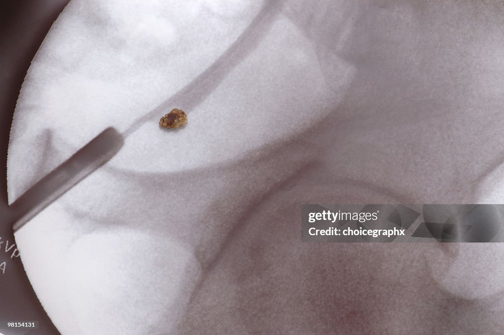 Kidney Stone Positioned on X-ray