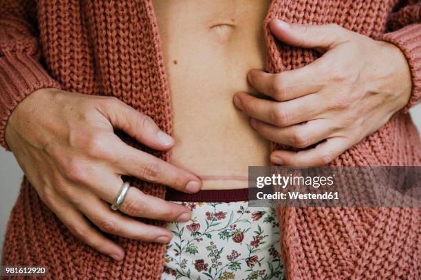 woman showing a cesarean section scar on her belly - cicatriz imagens e fotografias de stock