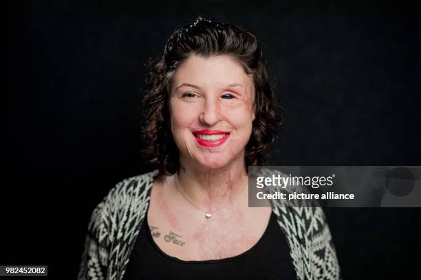 Acid attack victim Vanessa Muenstermann standing in a photo studio in Hanover, Germany, 05 February 2018. Two years ago, she was attacked by her...