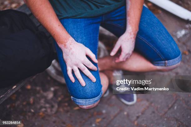 vitiligo - melanocito fotografías e imágenes de stock
