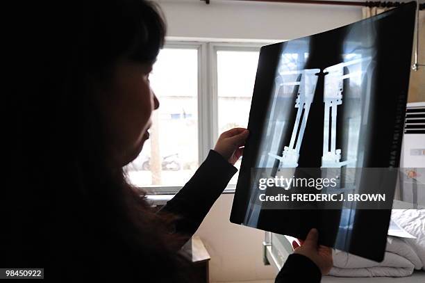 Health-China-lifestyle,FEATURE" by Pascal Trouillaud Former patient Wang Lijun, now working at the clinic, looks at an X-Ray of another patient who...