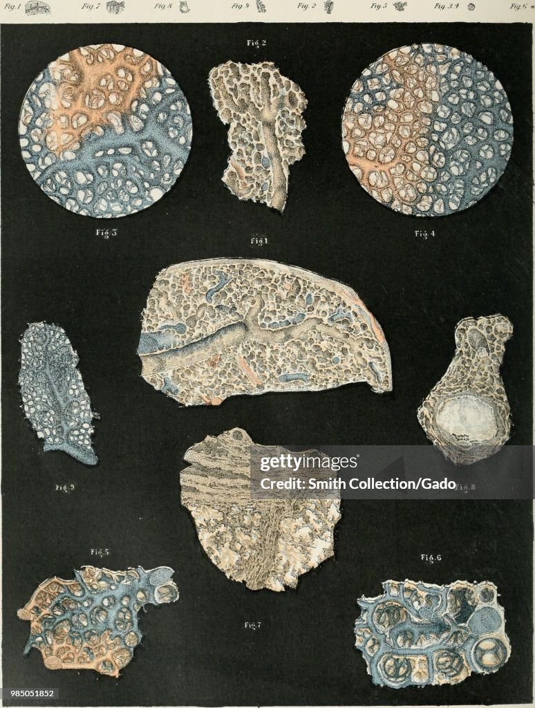 Tuberculosis Caseation