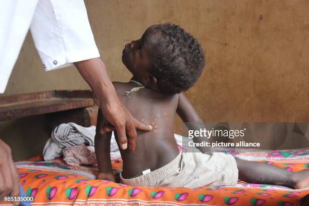 The two year old Tabidi, daughter of leper Le Zafy, is being examined for the possibility of leprosy in Marana, Madagascar, 23 January 2018. Despite...