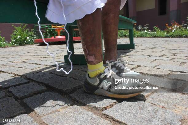 View of the typical leprosy spots on Marline Harisoa's skin in Marana, Madagascar, 23 January 2018. Marline Harisoa resides in the leprosy centre in...