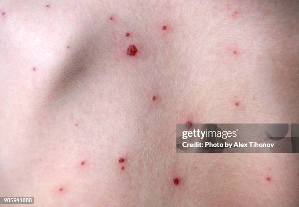 chickenpox - pox stock pictures, royalty-free photos & images