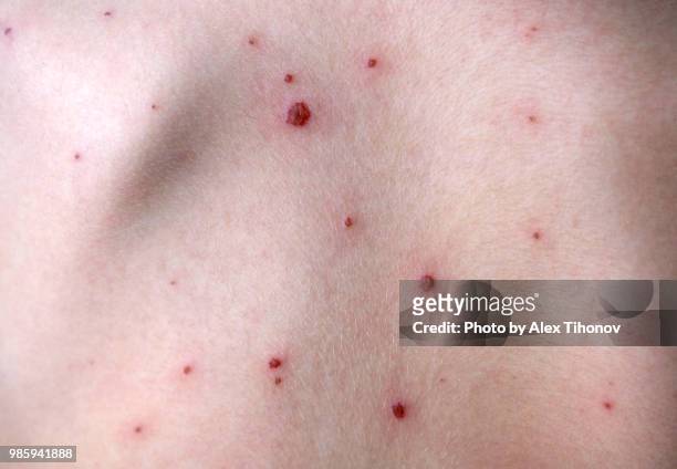 chickenpox - chickenpox 個照片及圖片檔