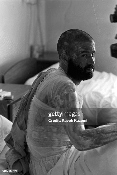 Man victim of a mustard gas attack by Saddam Hussein on frontier of Iran-Iraq, covered with blisters, sits on his bed, suffering of his wounds in...