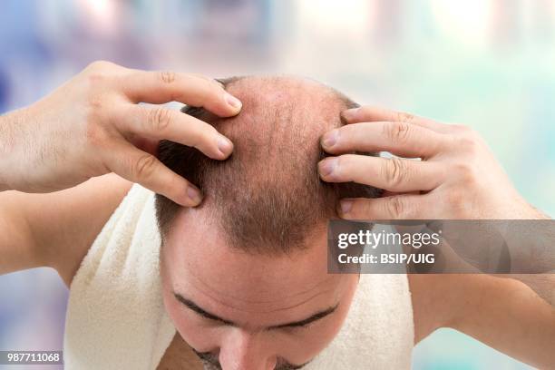 baldness. - bsip stockfoto's en -beelden