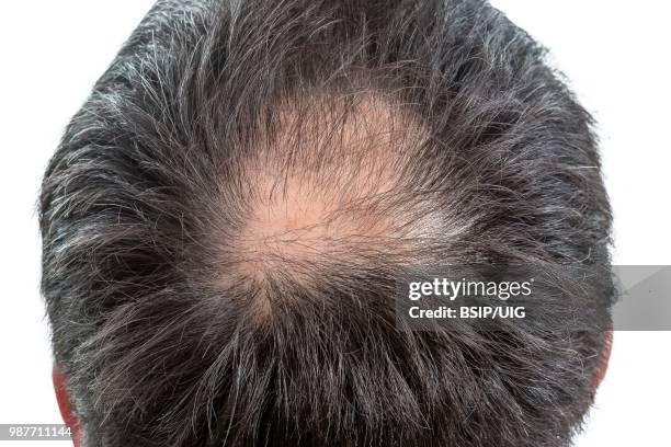 baldness. - bsip stockfoto's en -beelden