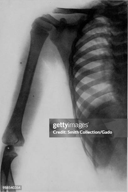 Black and white X-ray or Rontgen ray illustrating cellulitis of tissues of the left arm, following subcutaneous injection, in a nine-year-old male,...