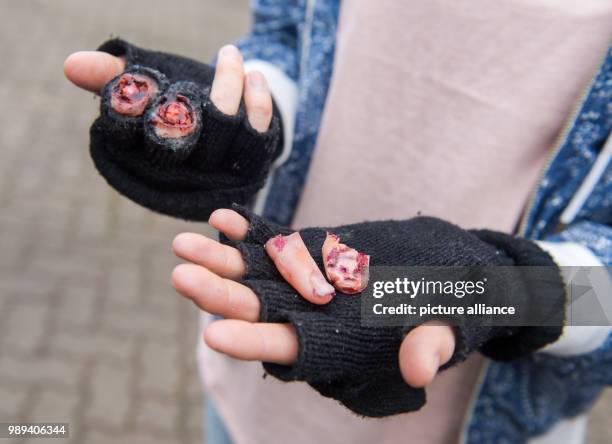 Young woman presents fake injuries that could be caused by fireworks during a presentation of the firebrigade on the dangers of wrong usage of...