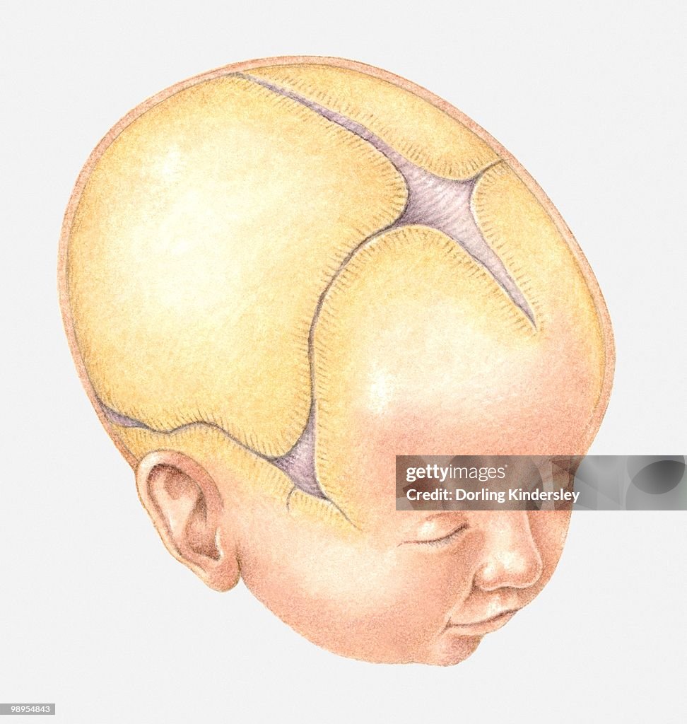 Coronal Suture Ridging Illustration Of Coronal Suture On Head Of Newborn Baby Illustration ...