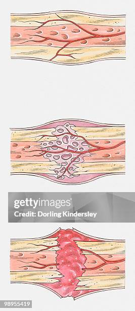 sequence of illustrations showing complete bone fracture and healing process - dorling kindersley stock illustrations