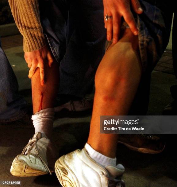 Winter Olympic Games : Salt Lake City, 2/24/02, Salt Lake City, Utah, United States --- Victims Of Police Shootings Show Their Injuries After Trigger...