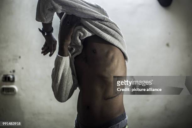 Dpatop - Haider showing a scar from a kidney surgery in Cairo, Egypt, 04 August 2017. The Sudanese man sold a kidney to organ traffickers according...