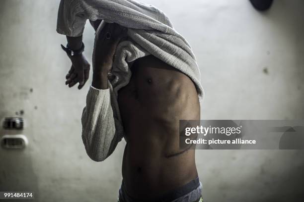 Dpatop - Haider showing a scar from a kidney surgery in Cairo, Egypt, 04 August 2017. The Sudanese man sold a kidney to organ traffickers according...