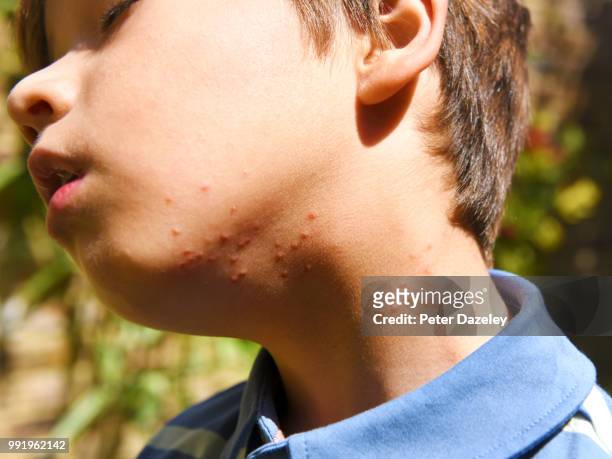 summer insect bites on boys neck - puntura di insetto foto e immagini stock