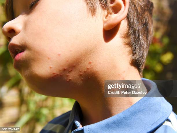 summer insect bites on boys neck - mite stock pictures, royalty-free photos & images