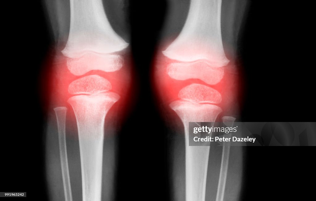 Knees with Arthritis