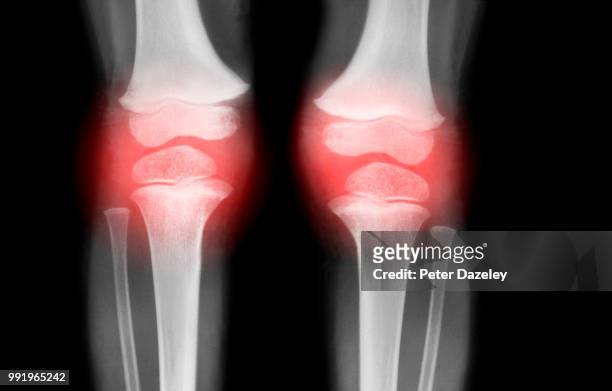 knees with arthritis - human knee stock pictures, royalty-free photos & images