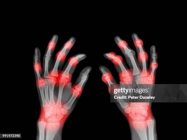 x-ray of painful hands - arthritis hands photos et images de collection