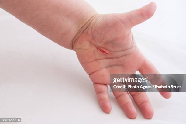 puncture wound - bruised finger stock-fotos und bilder