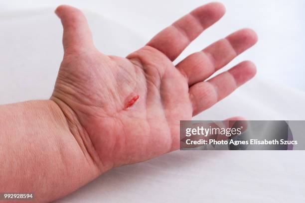 wound in handpalm - bruised finger stock-fotos und bilder
