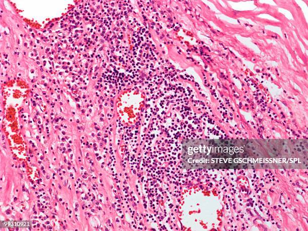 cardiovascular syphilis, light micrograph - treponema pallidum imagens e fotografias de stock