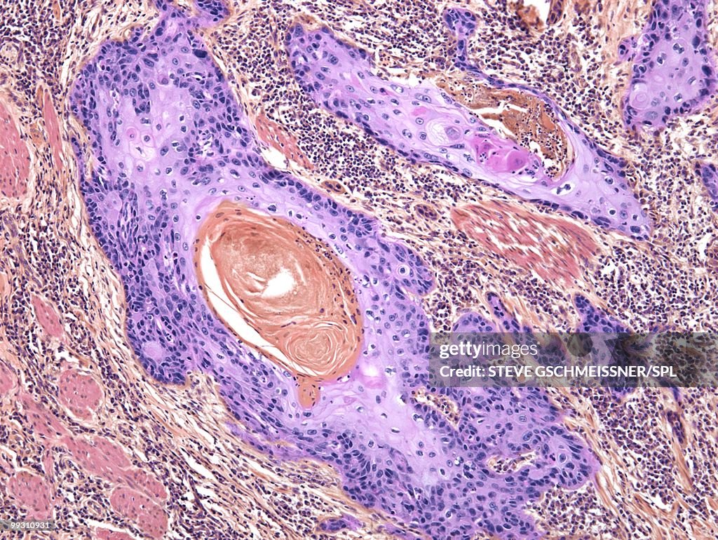 Skin cancer, light micrograph