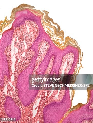 Wart, light micrograph Wart, light micrograph