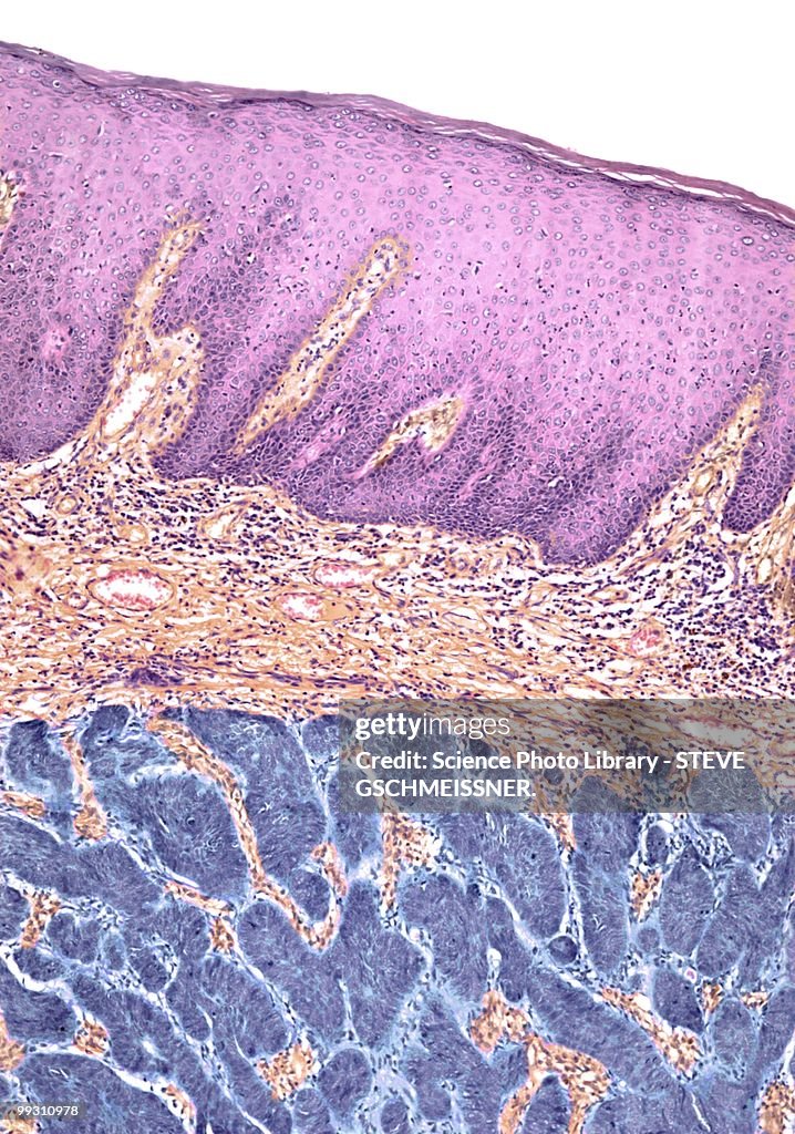 Skin cancer, light micrograph