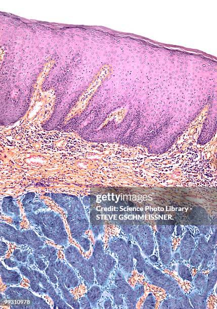 skin cancer, light micrograph - basalcellscancer bildbanksfoton och bilder