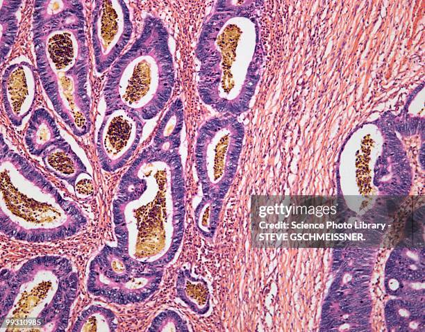colon cancer, light micrograph - intestino-grueso fotografías e imágenes de stock